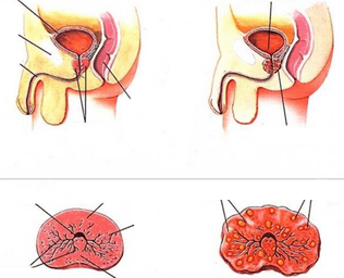 Normal prostate and chronic prostatitis