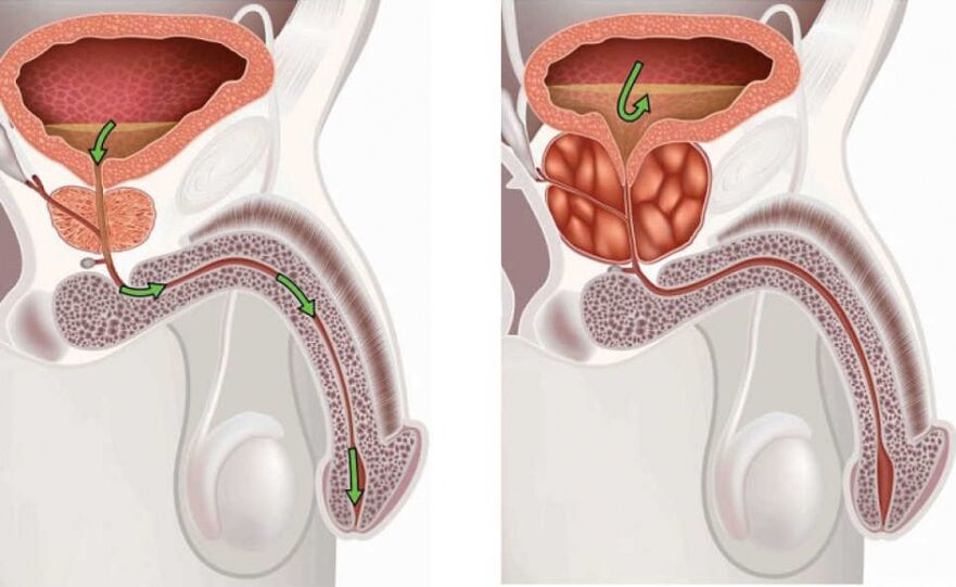 Men's health and diseased prostate