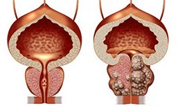 It is healthy and non-healthy prostate