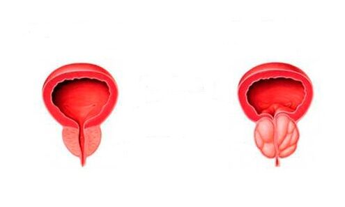 Healthy and inflamed prostate with prostatitis