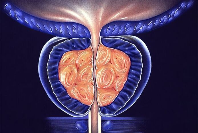 Prostatitis symptoms and treatment