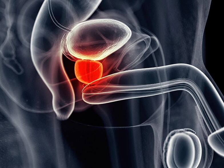 Prostatic inflammation accompanying chronic prostatitis